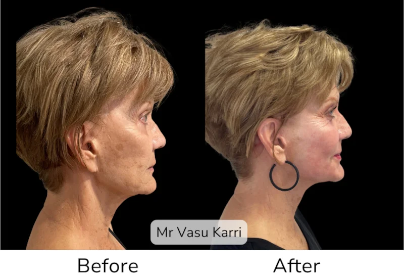 Facelift Patient 2 View 2